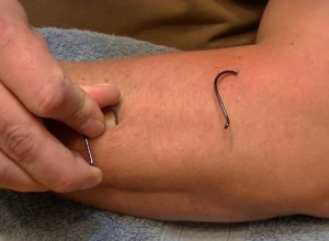 Fish hook removal video. It may come in handy...