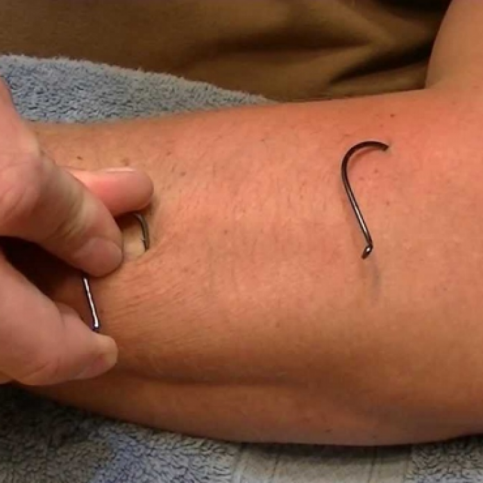 Fish hook removal video. It may come in handy